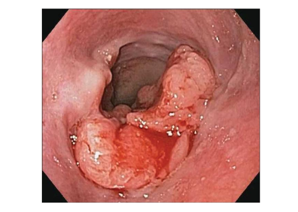 PHÁT HIỆN TỔN THƯƠNG UNG THƯ THỰC QUẢN QUA NỘI SOI TIÊU HÓA