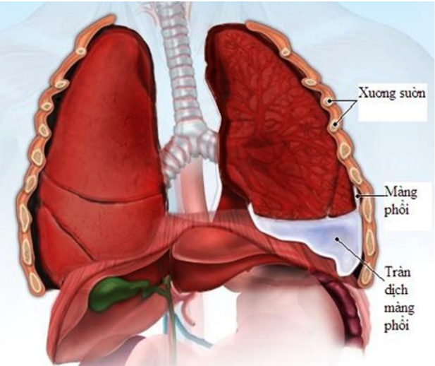 What are the symptoms of lung membrane cancer?
