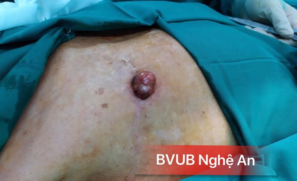 Bệnh polyp túi mật và cách điều trị